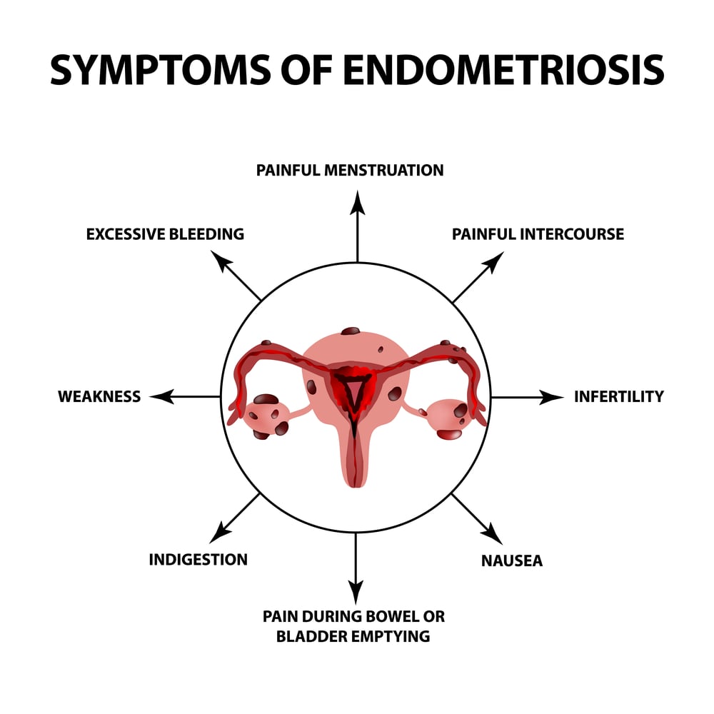 Endometriosis Symptoms