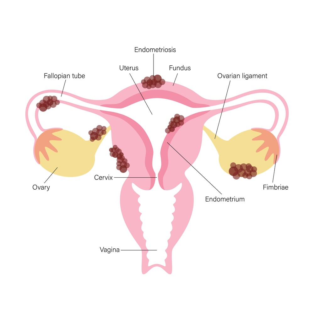 What Are Adhesions and How Are They Treated?